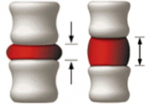 before and after spinal decompression treatment